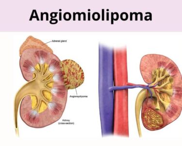 Angiomiolipoma Renal: Causas, Sintomas e Diagnóstico