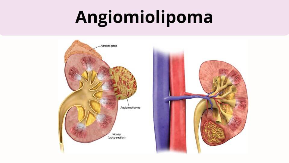 Angiomiolipoma Renal: 5 Causas, Sintomas e Tratamento