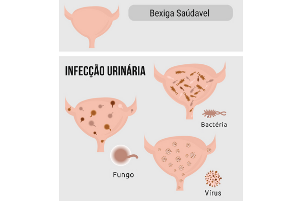 Infecção Urinária Recorrente Causas, Sintomas e Tratamento