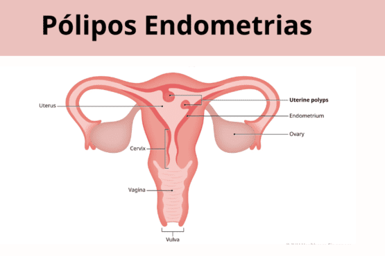 Pólipos Endometriais