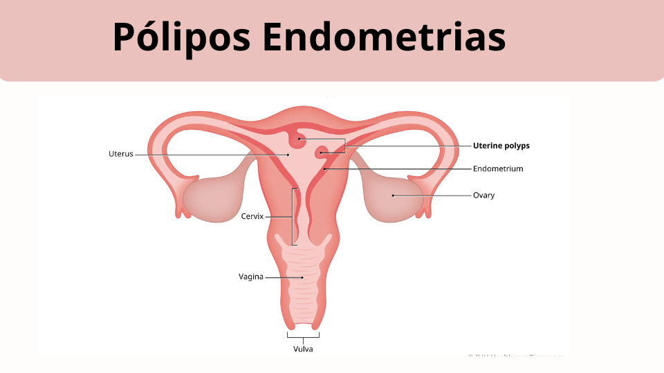O que é um Pólipo Endometrial?