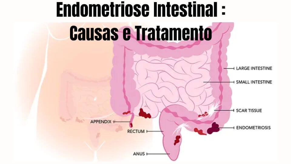 Endometriose Intestinal