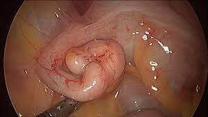 Endometriose intestinal e human norovírus in brazil