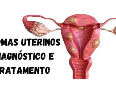 Miomatose Uterina ou Miomas uterinos Tratamento