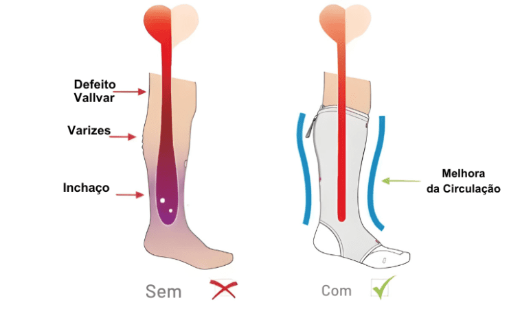 meias de compressão para Trombo