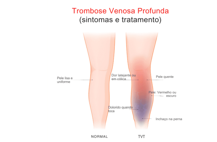 trombose sintomas